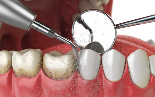 Dental Cleaning and Prevention