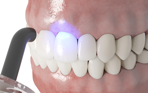 Dental Bonding and White Filling